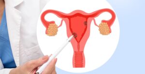 Leia mais sobre o artigo Câncer de útero apresenta maior risco em casos de excesso de peso em mulheres