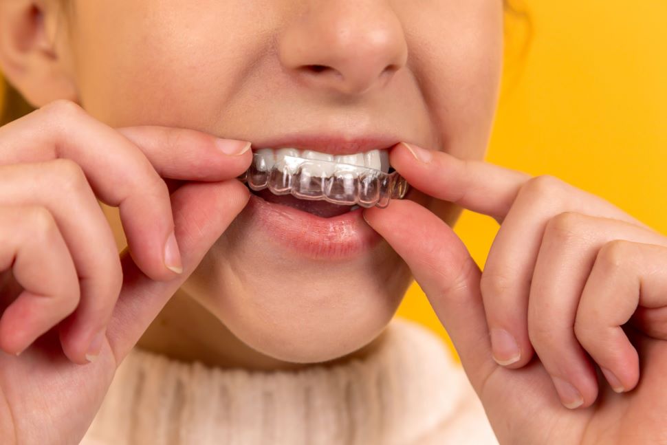 No momento, você está visualizando Entenda a diferença entre aparelhos e alinhadores dentários