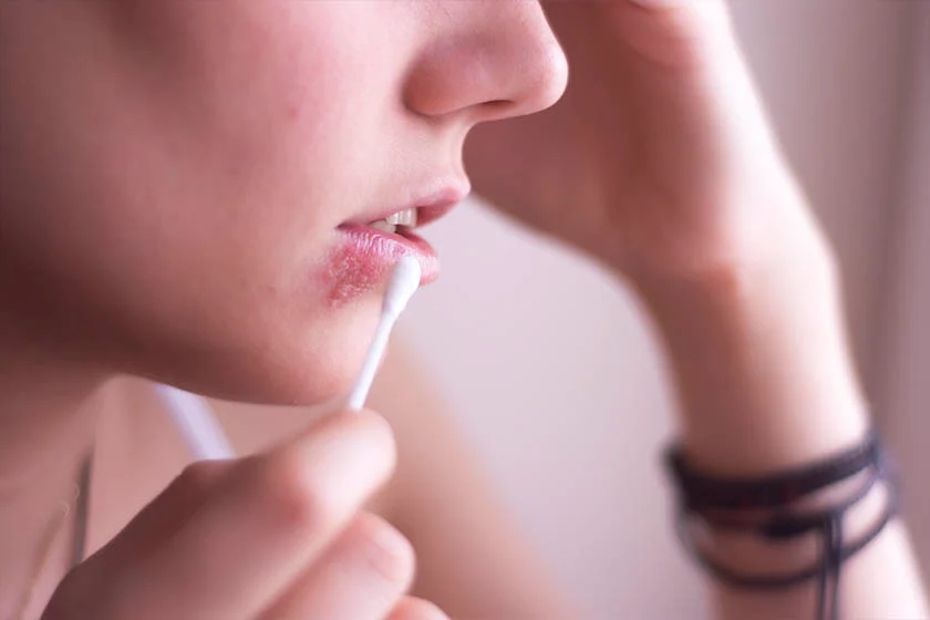 No momento, você está visualizando Vírus da herpes modificado injetado em tumor freia câncer terminal