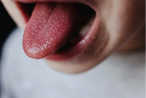 Leia mais sobre o artigo STREP A: A bactéria que já matou 6 crianças no Reino Unido