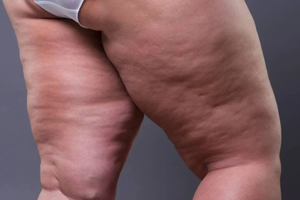 No momento, você está visualizando Gordura subcutânea pode proteger contra demência e AVC