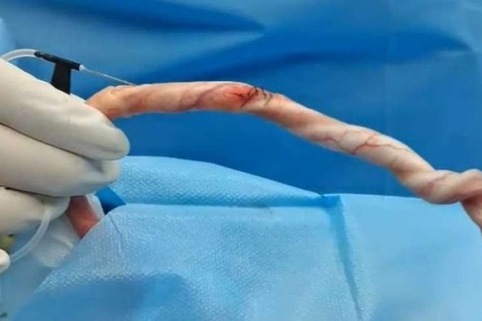 No momento, você está visualizando Tecido artificial restaura lesões penianas e recupera função erétil