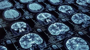 Leia mais sobre o artigo Remédio que silencia proteína promete retardar o Alzheimer