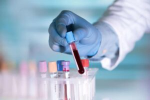 Leia mais sobre o artigo Exame de sangue poderá diagnosticar câncer de intestino com alta precisão