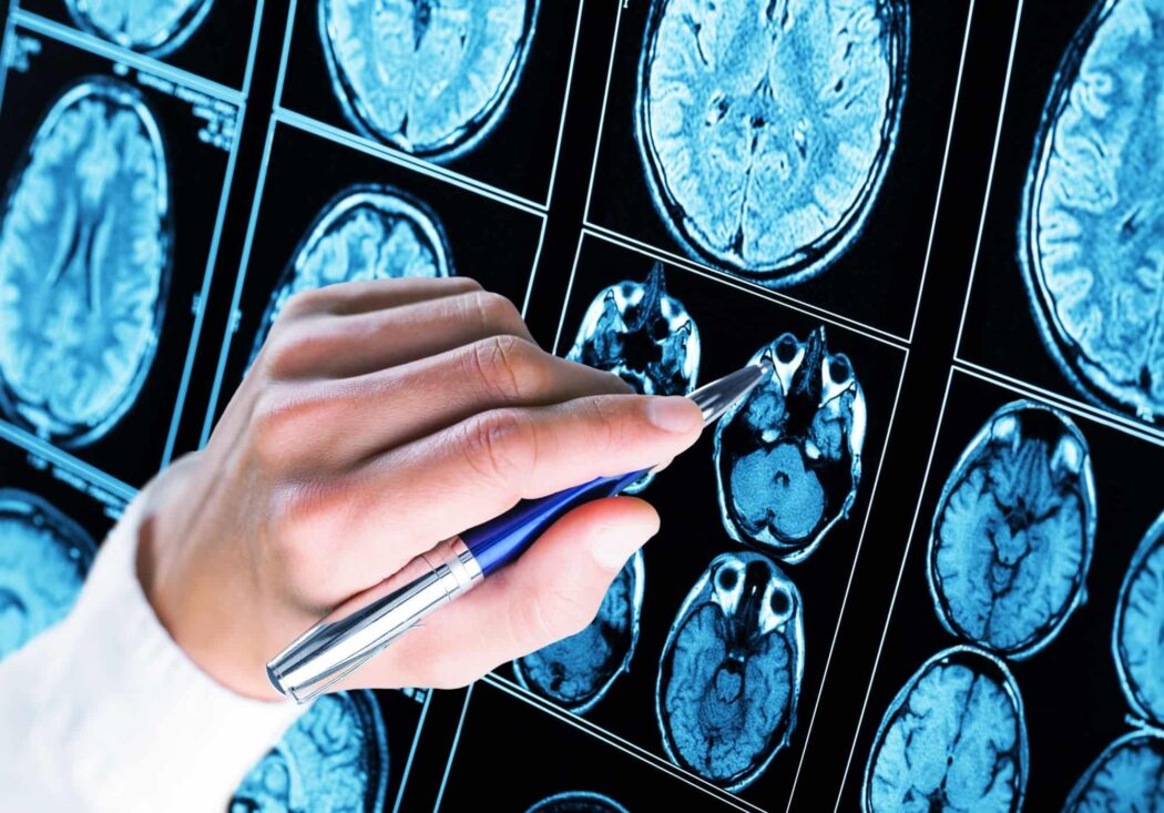 No momento, você está visualizando Saiba como é o primeiro chip para epilepsia do mundo