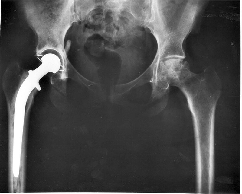 No momento, você está visualizando Simples mudança pode tornar implantes de quadril e joelho mais seguros; saiba qual