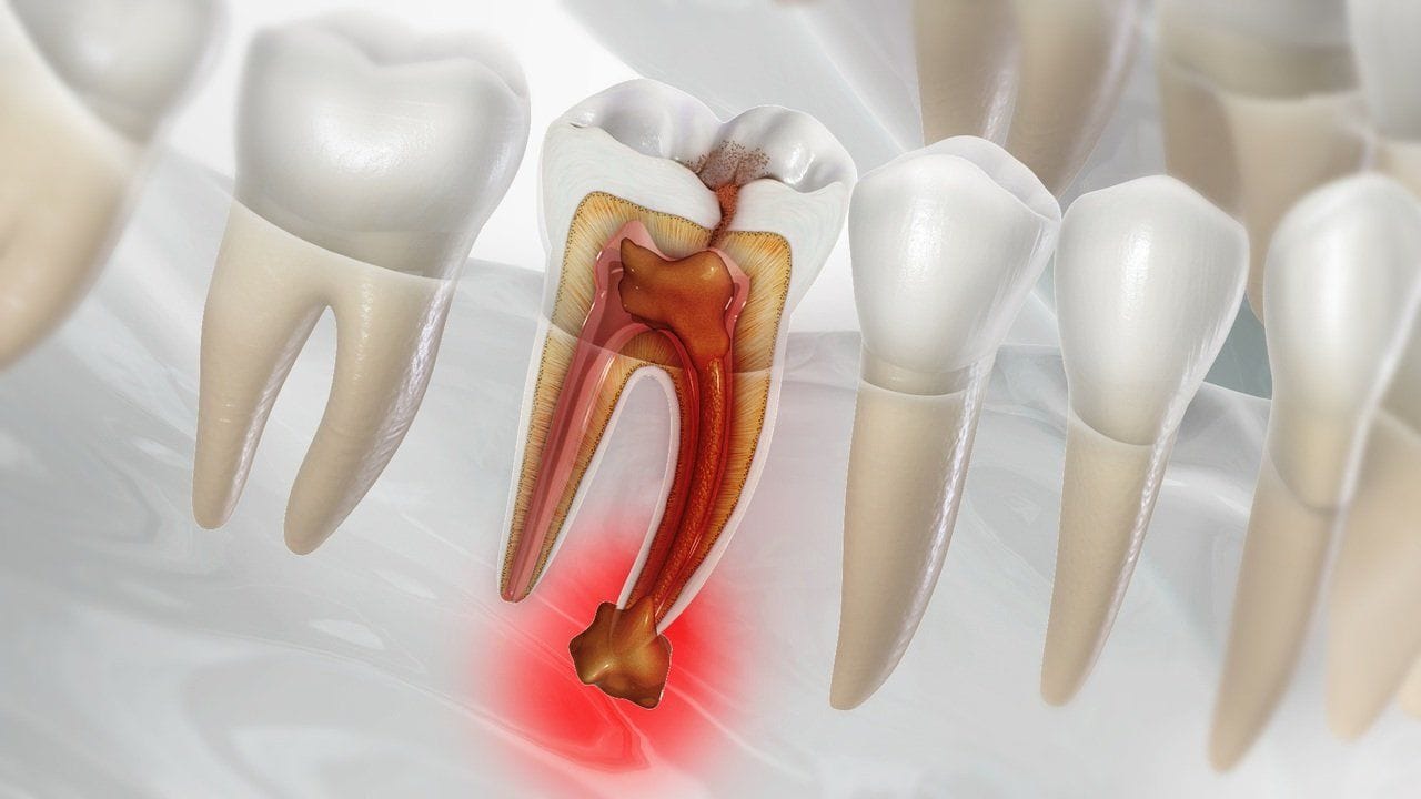 No momento, você está visualizando Exercício físico e ômega-3 ajudam a reduz gravidade de infecção dental