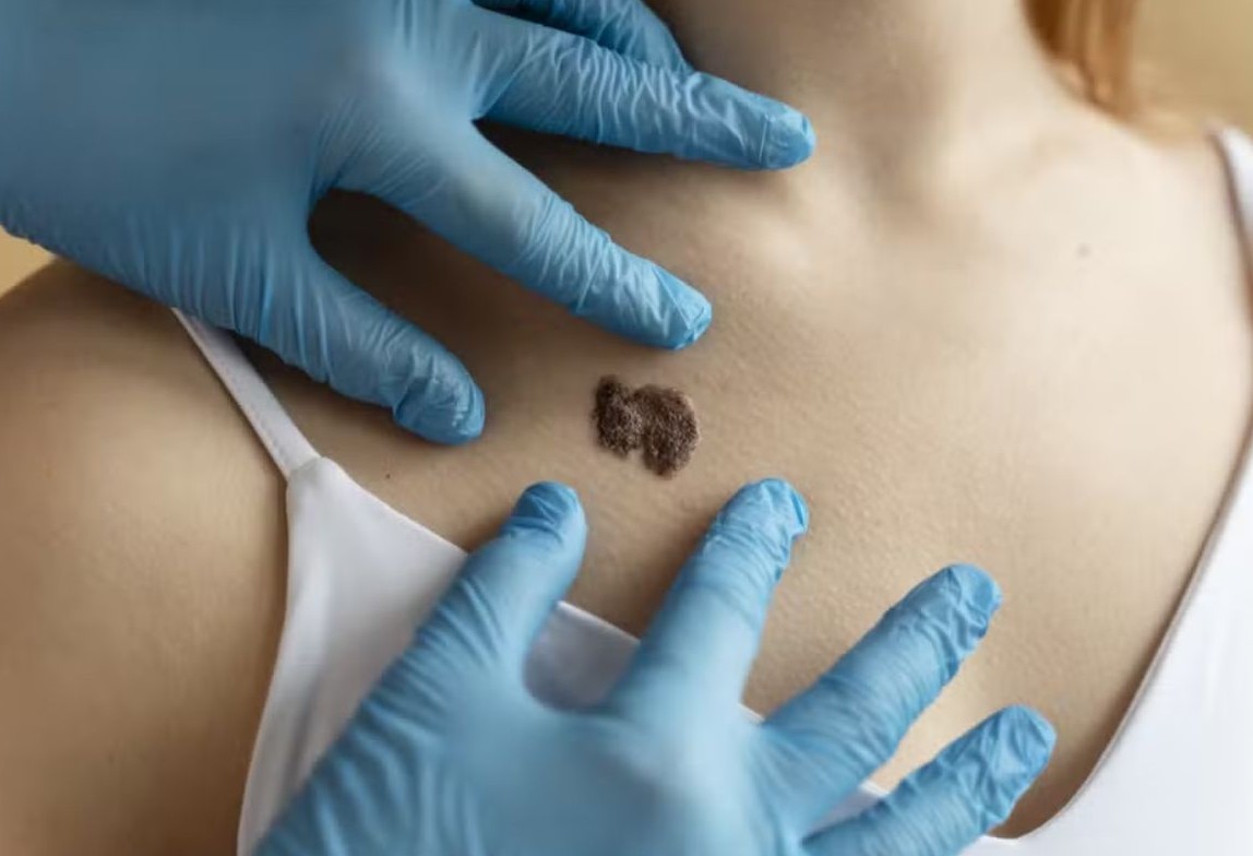 No momento, você está visualizando IA combina imagem e dados clínicos e detecta câncer de pele agressivo